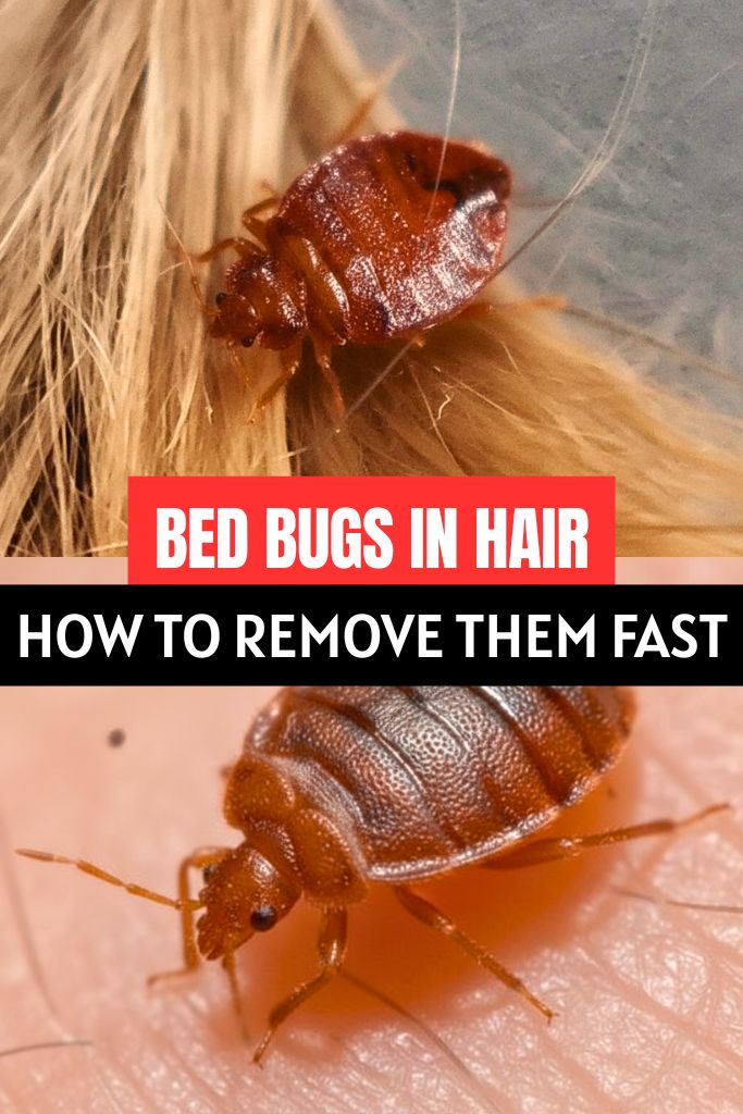 Bed Bugs in Hair